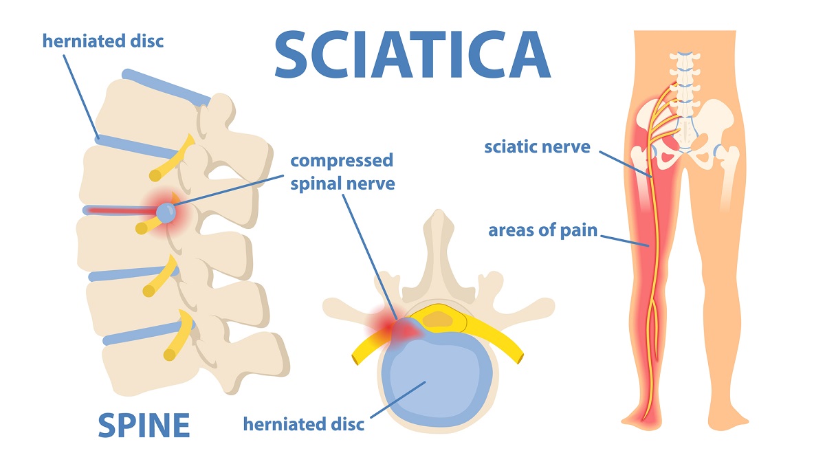 Sciatic nerve pain in the lower back through hip, thigh, knee to leg